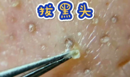 挤黑头的视频,告别毛孔堵塞烦恼